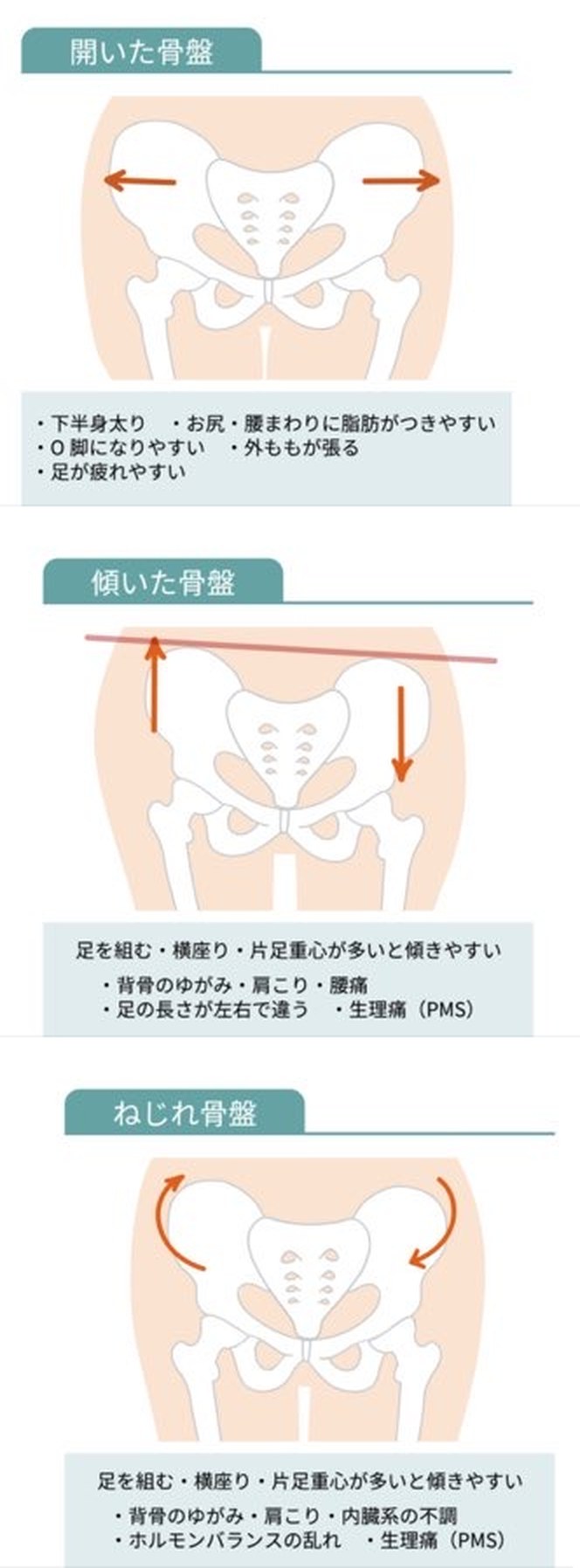 開いた骨盤・傾いた骨盤・ねじれ骨盤の違い